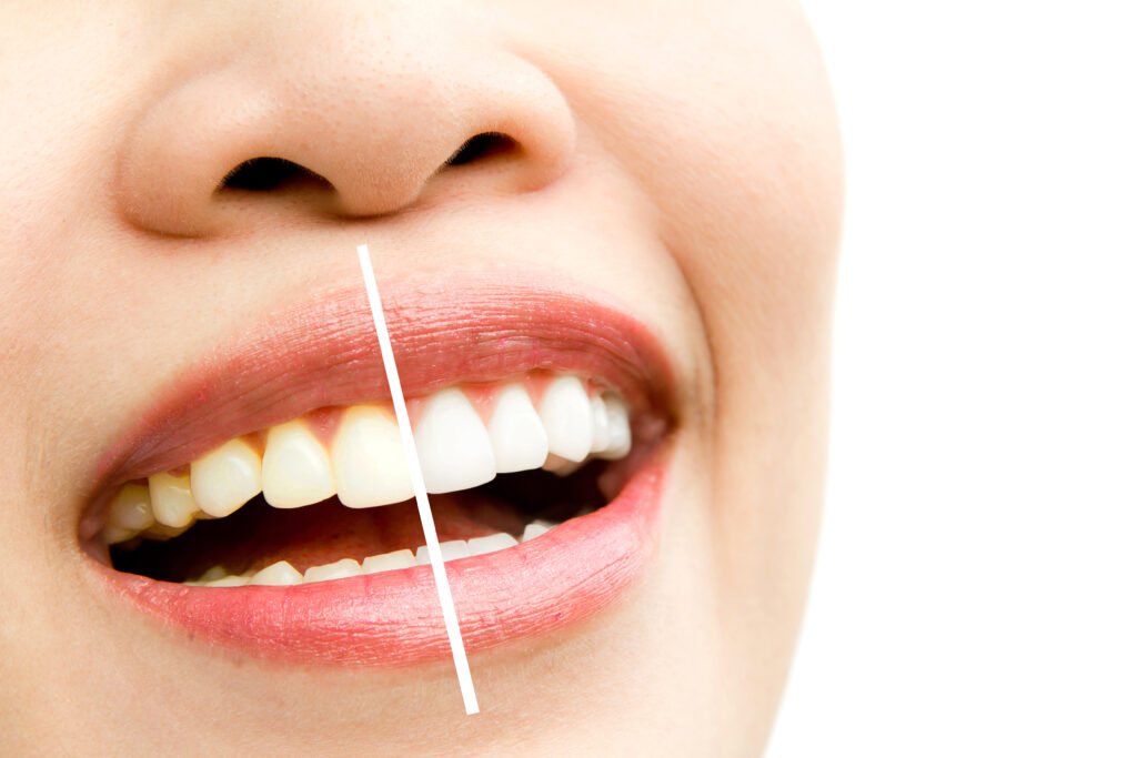 Teeth Whitening in Hadapsar