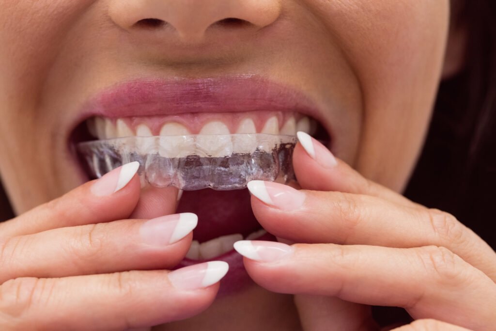 Braces vs Clear Aligners