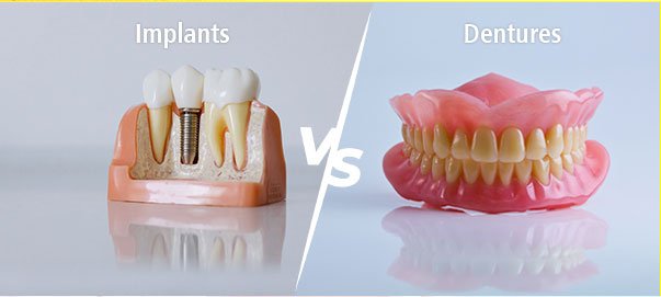 Dental Implants vs Dentures